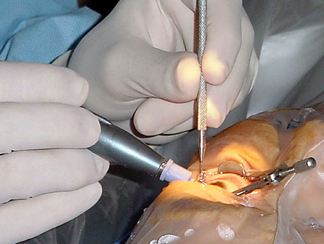 File:Cataract surgery.jpg