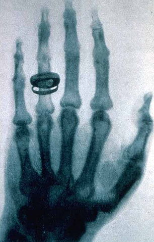 File:X-ray by Wilhelm R&ouml;ntgen of Albert von K&ouml;lliker's hand - 18960123-02.jpg