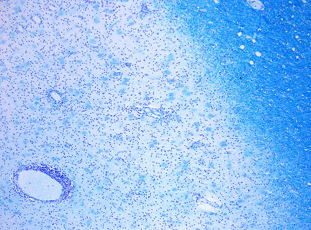 File:MS Demyelinisation KB 10x.jpg