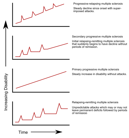 File:Ms progression types.svg