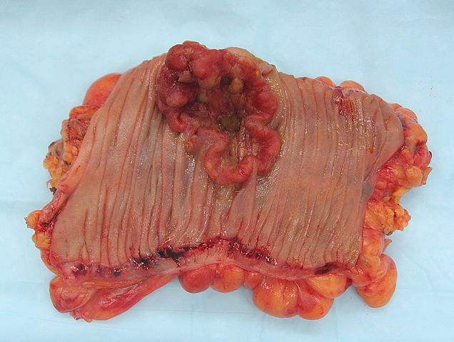 File:Colon cancer 2.jpg