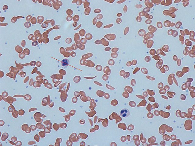 File:Sickle cells.jpg