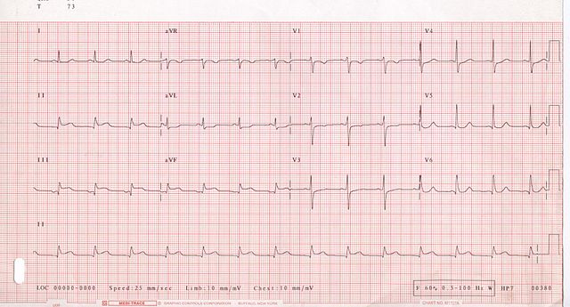File:ECG 001.jpg