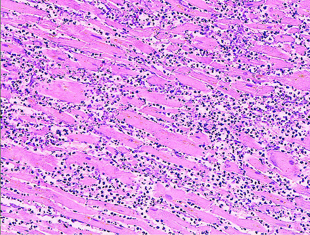 File:Myocardial infarct emmolition phase histopathology.jpg