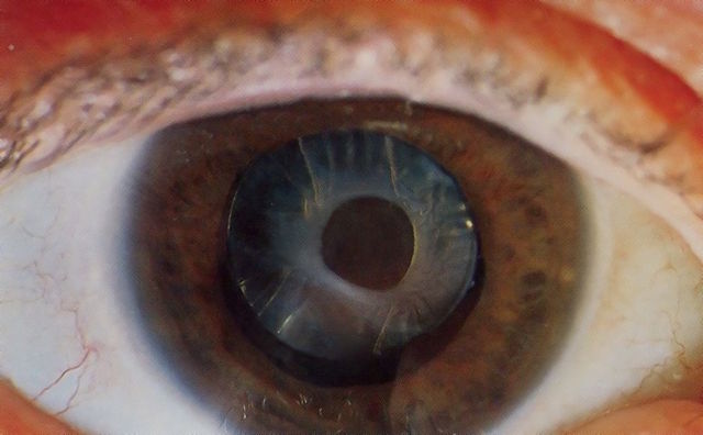 File:Anterior capsular opacification.jpg