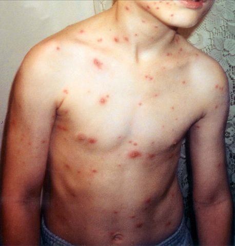 File:Child with chickenpox.jpg
