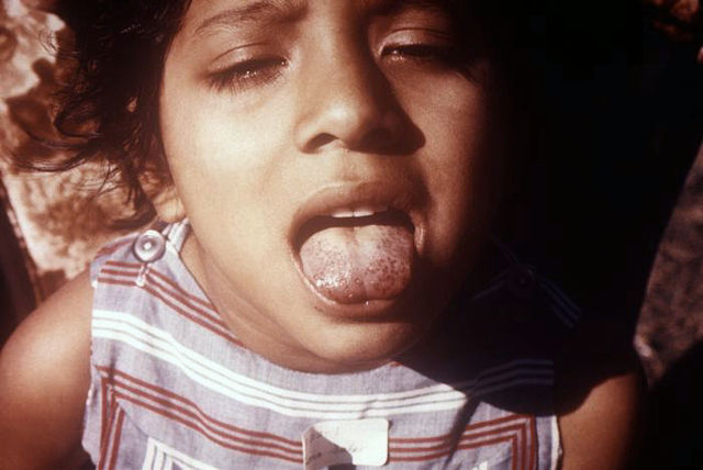 File:Scorbutic tongue.jpg