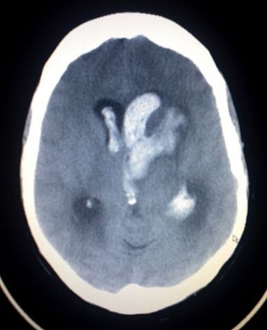 File:Intracerebral heamorrage 2.jpg