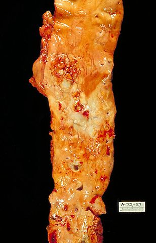 File:Atherosclerosis, aorta, gross pathology PHIL 846 lores.jpg